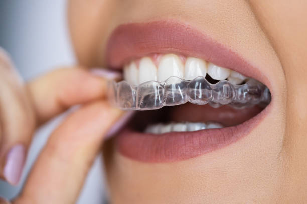 Close-up of a clear aligner being placed over teeth