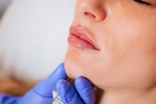 Lip filler consultation at Dentistry on 66 in Yorkville, Toronto
